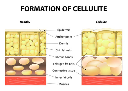 Carolas Kosmetikstudio - Cellulite Behandlung